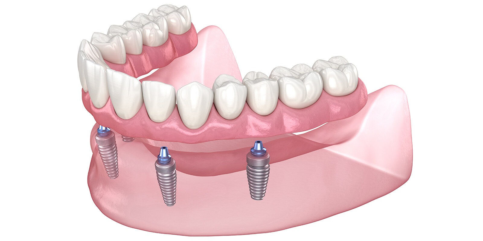 インプラントオールオン４の費用相場