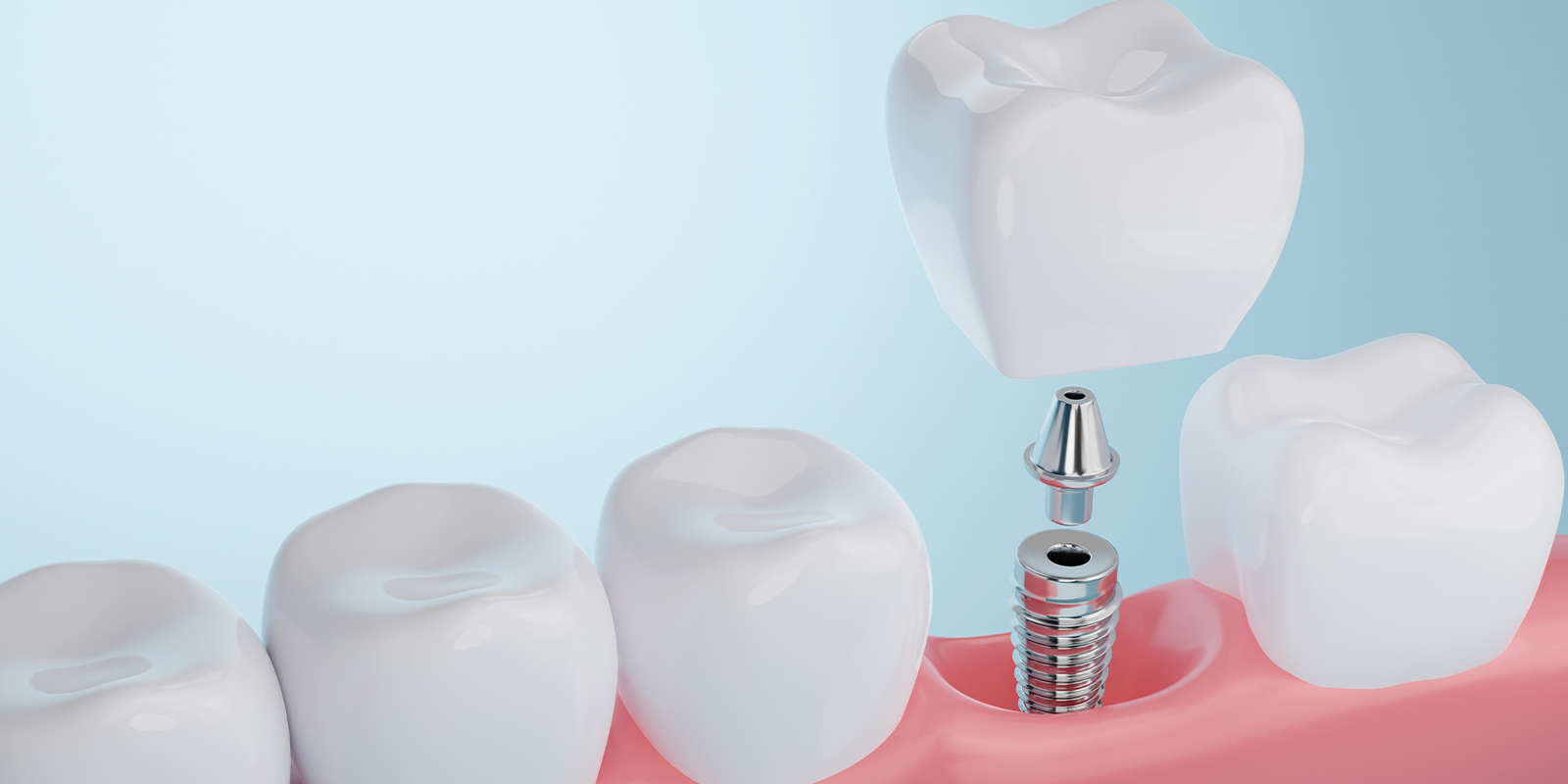 インプラントの費用（値段・平均価格・金額・料金）は前歯と奥歯で違う？