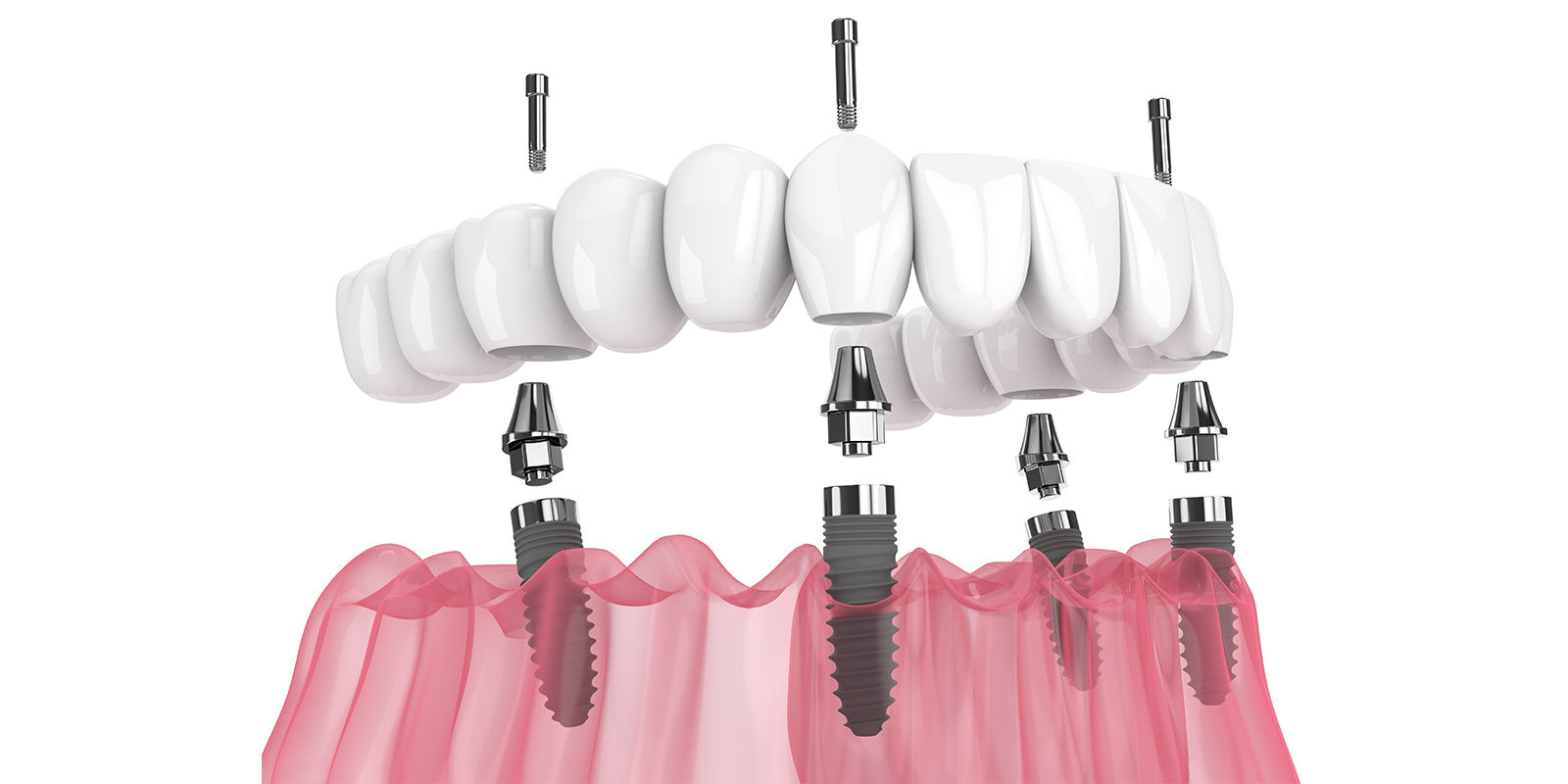 インプラントの値段（費用）：複数〜全部を安く治療する方法について
