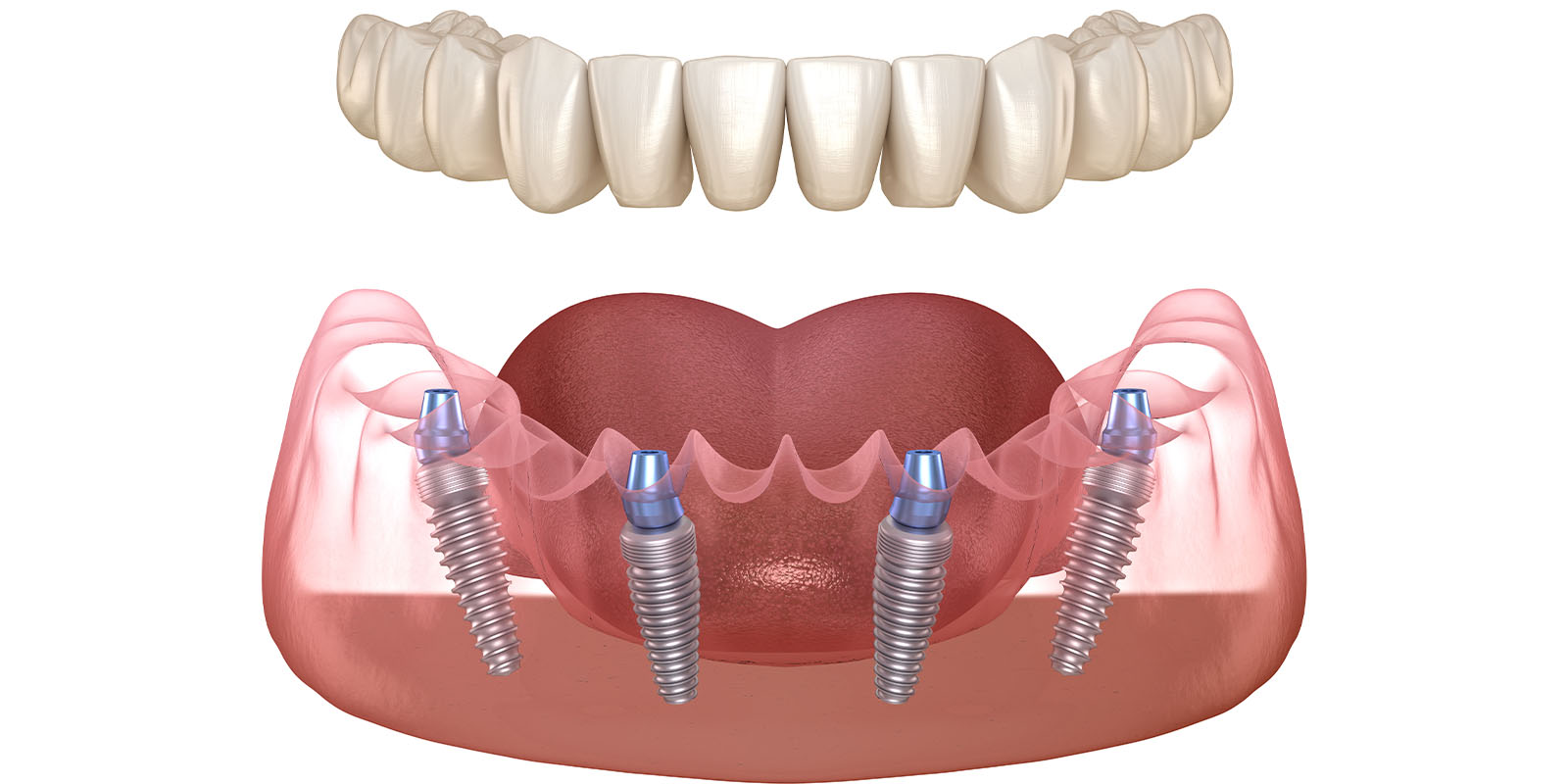 お一人で悩まず「インプラント相談」を遠慮なくご活用ください